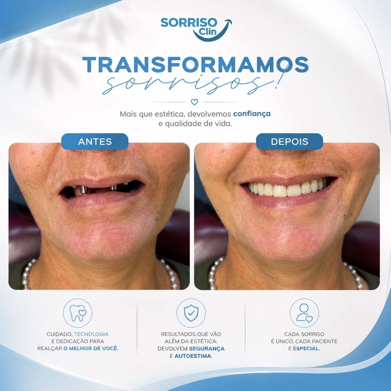 Comparativo antes e depois de reabilitação de sorriso realizada na Sorriso Clin