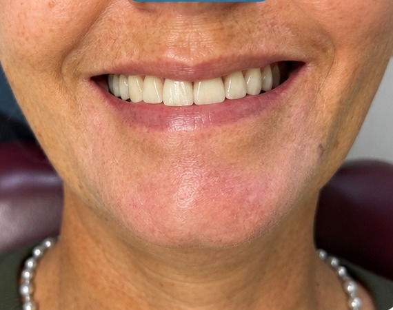 Sorriso do paciente depois do tratamento reabilitador na Sorriso Clin